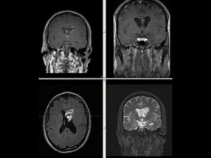 Hydrocephalus - Head MRI • Video • MEDtube.net