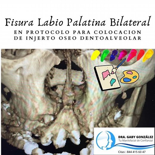 Cirugía Maxilofacial Saltillo - Labio Paladar Hendido - Fisura Labiopalatina - Labio Leporino