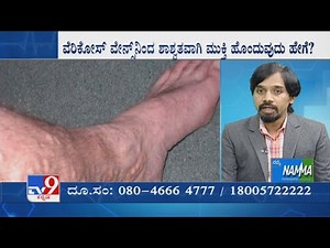 Nimma Doctor | Homeopathic treatment for Varicose veins | Namma Homeopathy