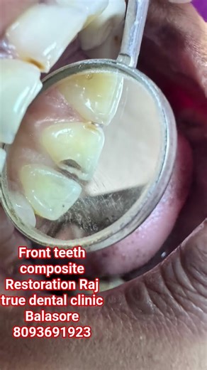 #composit #dentist #frontteeth composite Restoration