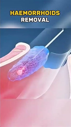 Prostate Biopsy Procedure Explained | 3D Animation #ProstateBiopsy #MensHealth