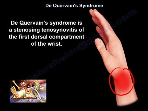 De Quervain's Syndrome - Everything You Need To Know - Dr. Nabil Ebraheim