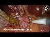 Laparoscopic CBD Exploration, Antegrade Sphincterotomy, CBD Stent • Video • MEDtube.net