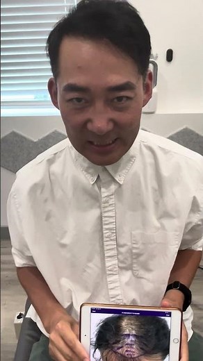 STEM CELL Hair Restoration for Hair Loss 1 year update with before and after photos