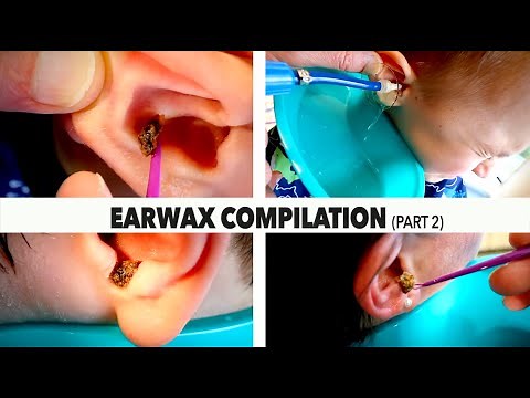MASSIVE EARWAX REMOVAL COMPILATION (Part 2) | Dr. Paul