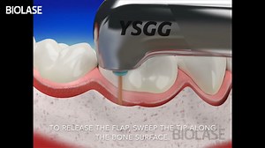 Open Flap for Perio Pathology