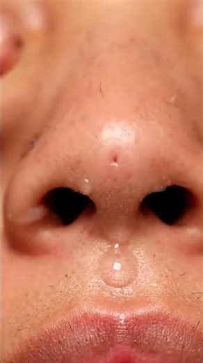 Blackhead Explosion! Wait Till the End!”