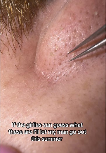 Tweezing the skin with tweezers ♥️ #skin #skincare #tweezers #pimplepopping #pimples