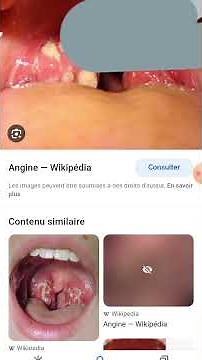Angine Blanche symptome et Traitements
