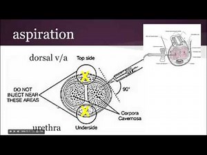 Priapism  • Video • MEDtube.net
