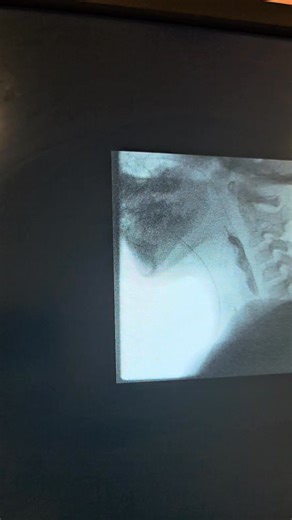 Evelyn's swallow study went well. She's not able to drink fluids yet, but she is allowed to eat solids and thickened fluid. Hopefully, we'll be pulling her NG tube later today. This is what it looks like when you eat a pretzel. | EvelynStrong