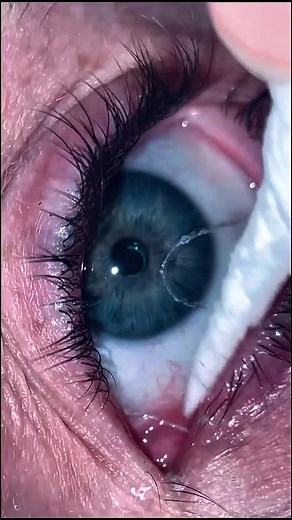 Eye mucous fishing on TikTok