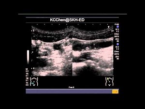 Appendicitis