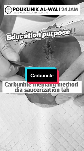 Carbuncle bukan bisul biasa. Ia jangkitan kulit yang lebih dalam dan kumpulan beberapa bisul yang bercantum — sebab tu sakitnya kuat dan cepat membesar. Dalam video ni doktor sedang bersihkan luka untuk keluarkan nanah & tisu dijangkiti supaya jangkitan tak merebak. Kalau ada benjolan merah, panas, berdenyut atau mula bernanah — itu tanda awal carbuncle. Rawat awal untuk elakkan parut besar dan jangkitan makin teruk. Dapatkan rawatan lanjut di Poliklinik Al-Wali ✨ 📍 Cawangan Balik Pulau 📍Cawan