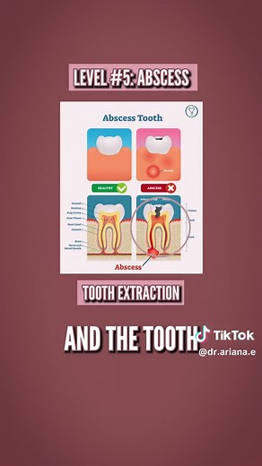 Understanding the 5 Levels of Tooth Decay