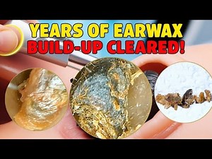 Earwax Removal | Deep Earwax Removal | ASMR | Earwax Removal Video