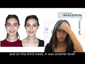 Jaw surgery Case # 87: Luna - Class II, facial asymmetry