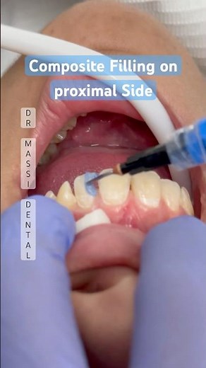 CL II Composite Filling on Front Tooth