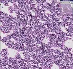 Histopathology Lung--Hyaline membrane disease