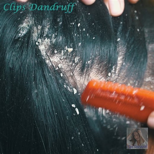 A Complete Guide to Scalp Care for Dandruff Solutions! 424 | Clips Dandruff