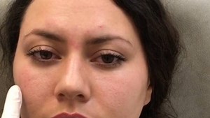 18K views · 16 reactions | Watch Dr. Kelleher use dermal fillers to add fullness and lift to the face in an actual live procedure. #dermatology | Premier Dermatology | Facebook