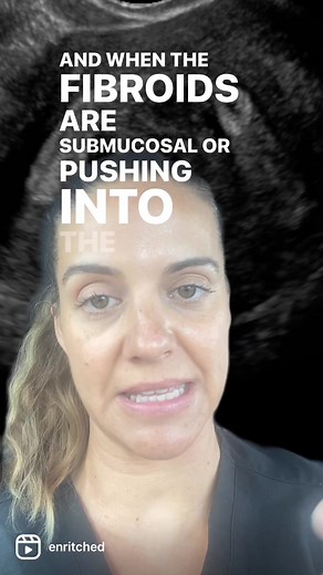 For #submucosalfibroids pushing into the uterine cavity, #hysteroscopicmyomectomy is the best option. It’s a quick procedure with no incisions and minimal recovery time and it can make a big difference. #fibroidawareness
