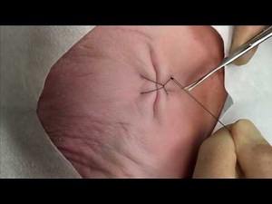 Horizontal Mattress Suture with Locking