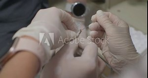 Close-up of a biopsy being placed in a test tube with endoscopic forceps. Taking a biopsy during endoscopy for histological examination. A piece of biopsy is placed in a jar with formalin.