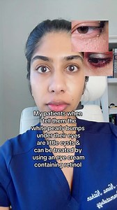 136K views · 381 reactions | Milia are little cysts that commonly...