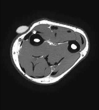 Extensor pollicis tendon anatomy