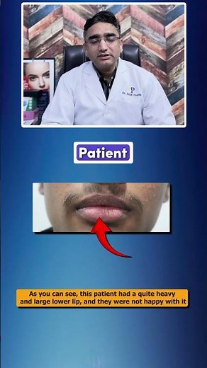 Lip Reduction Surgery for Smaller Lips - Reduce your Lip Size!!