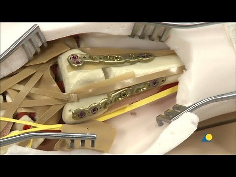 Radius, Distal - Intraarticular Fracture - Dorsal Double Plate Fixation Using VA-LCP Plates