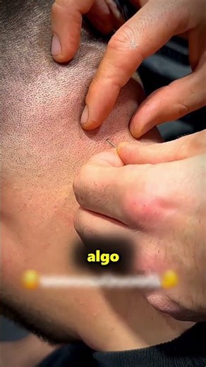 This guy's hair grew inwards 🤯