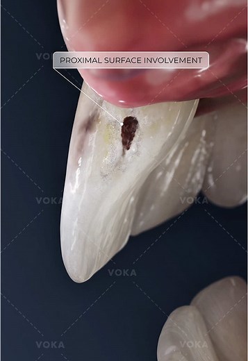 Understanding Class III Carious Lesions and Their Impact
