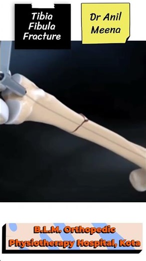 Tibia fibula fracture recovery time |Tibia fibula fracture healing time | tibia fracture #shortsfeed