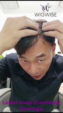 Hair Loss Solutions Singapore | Finding the Right Path to Confidence