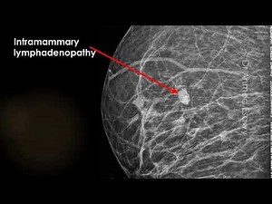 CASE 538 mammography Intramammary lymphadenopathy