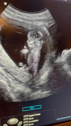 This little one is already waving… maybe trying to flag down Santa early! 🎅👶✨ Wishing everyone a magical Christmas Eve filled with tiny miracles and big smiles! 🎄💛 #SeeMe3D4D #BabyWave #SantaCountdown #ChristmasEveMagic #TinyMiracles #HolidayJoy | See Me 3D 3D/ 4D Ultrasounds
