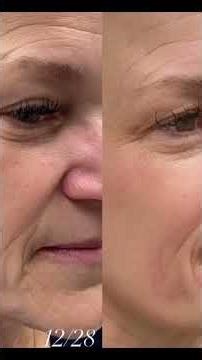 Plasma fibroblast in action—tightening, lifting, and refining the skin for youthful look. ✨