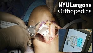 Proximal Tibial Anterior Closing Wedge Osteotomy With Revision ACL Reconstruction and Modified Lemaire Using PSI