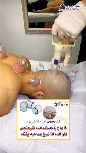 فوائد الحجامة على الراس لمن يعاني من تهيج الد_م #الحجامة_الجافة #الحجامة