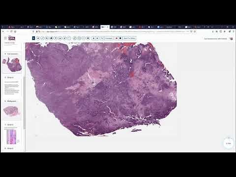 Digital Surgical Pathology 32 A Case of Carcinosarcoma of the Uterus
