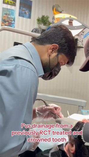 Understanding Pus Drainage After Root Canal Treatment