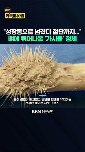 'Numerous' sharp thorns on the kneecap? A condition that can lead to serious consequences if left...