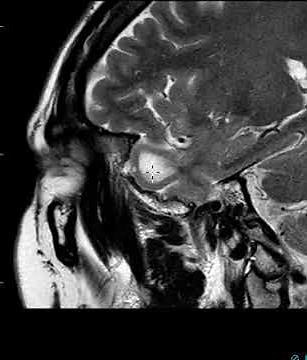 Low grade glioma temporal lobe