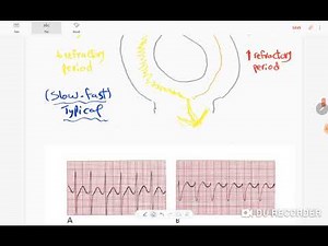ECG دروس تخطيط القلب 7 التسارعات فوق البطينية SVT: AVNRT vs AVRT