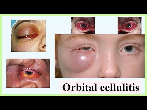 orbital cellulitis