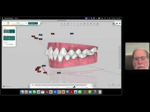 sequential aligners staging inital concept.