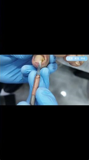 Paronychia is a nuisance; correction can solve it. #foot #pets #nurse