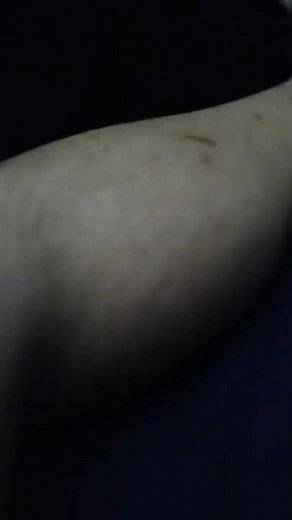 Muscle Cramp / Charlie Horse